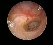 3.1 耳道杀手——外耳道胆脂瘤478.png
